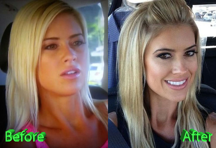 Christina El Moussa Before and After Plastic Surgery