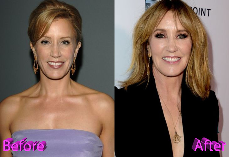 Felicity Huffman Plastic Surgery: Was It A Good Idea Though?