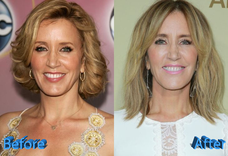Felicity Huffman Before and After Plastic Surgery
