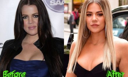 The History of Khloe Kardashian Plastic Surgery Procedures