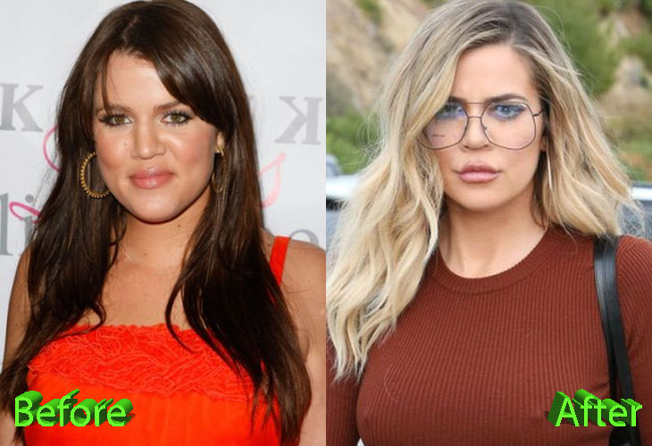 Khloe Kardashian before and After Cosmetic Surgery