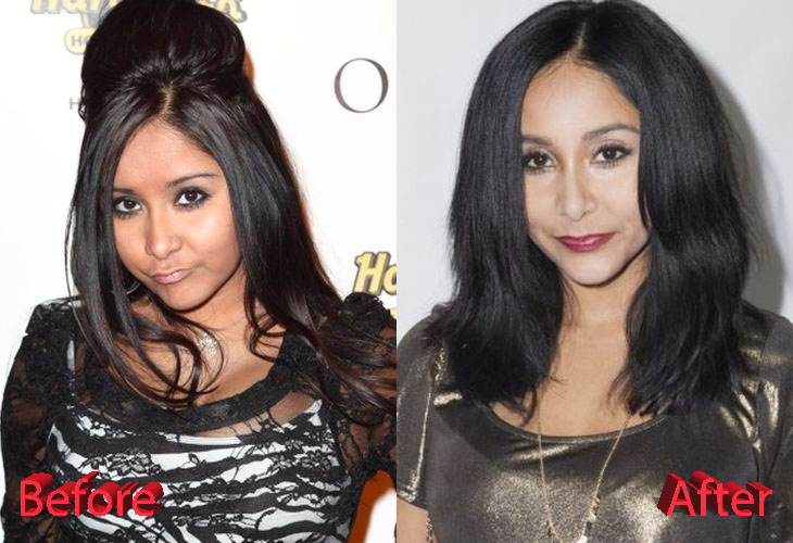 Snooki Before and After Plastic Surgery