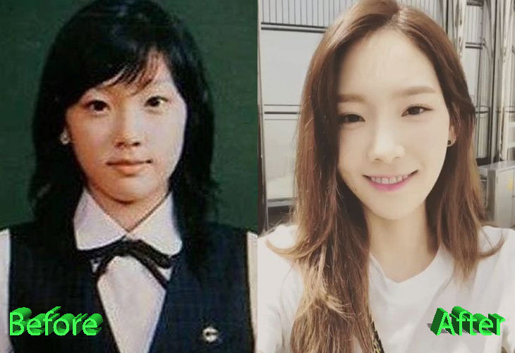 Taeyeon Before and After Cosmetic Surgery