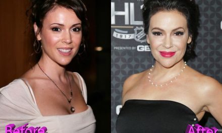 Alyssa Milano Plastic Surgery: And What Do You Think Of It?