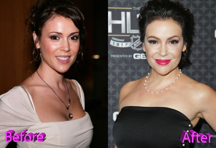 Alyssa Milano Before and After Cosmetic Surgery