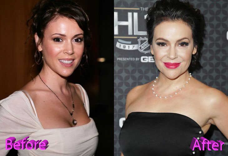 Alyssa Milano Plastic Surgery: And What Do You Think Of It?