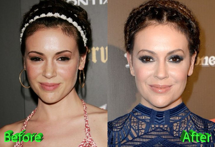 Alyssa Milano Before and After Plastic Surgery