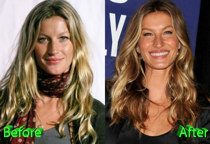 Gisele Bundchen Before and After Cosmetic Surgery