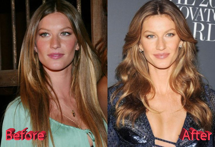 Gisele Bundchen Before and After Plastic Surgery