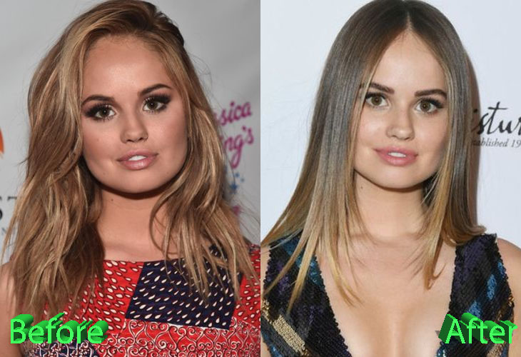 Debby Ryan Before and After Plastic Surgery