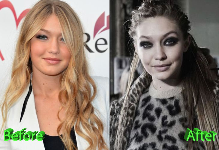 Gigi Hadid Before and After Cosmetic Surgery