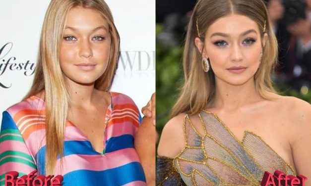 Gigi Hadid Plastic Surgery Before and After