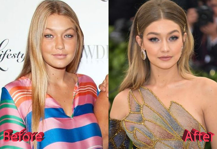 Gigi Hadid Before and After Plastic Surgery