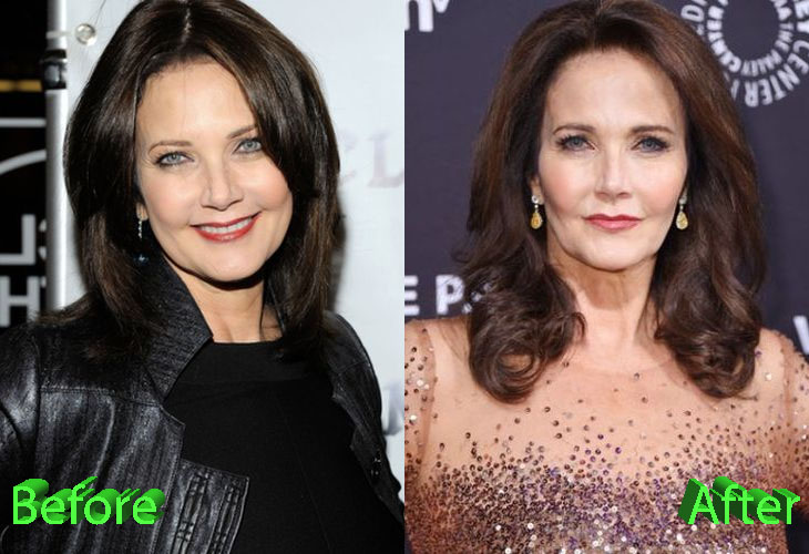Lynda Carter Before and After Cosmetic Surgery