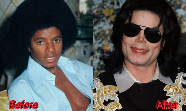 Michael Jackson plastic surgery procedures