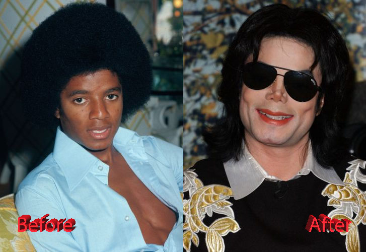 Michael Jackson plastic surgery procedures