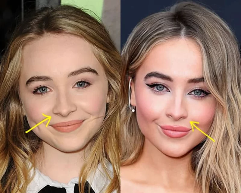 Sabrina Carpenter Nose Job Plastic Surgery Rumors Explained: Secret to Perfection!