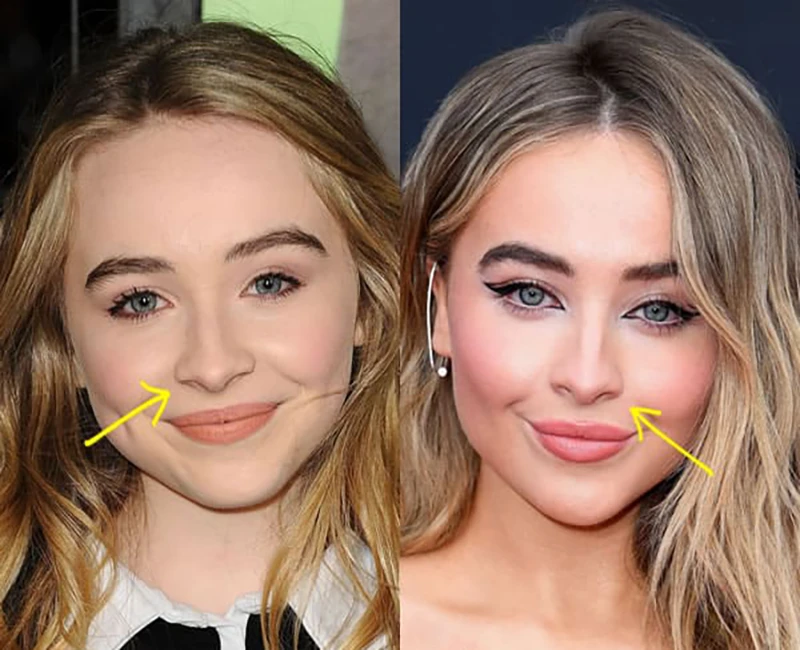 Sabrina Carpenter Plastic Surgery