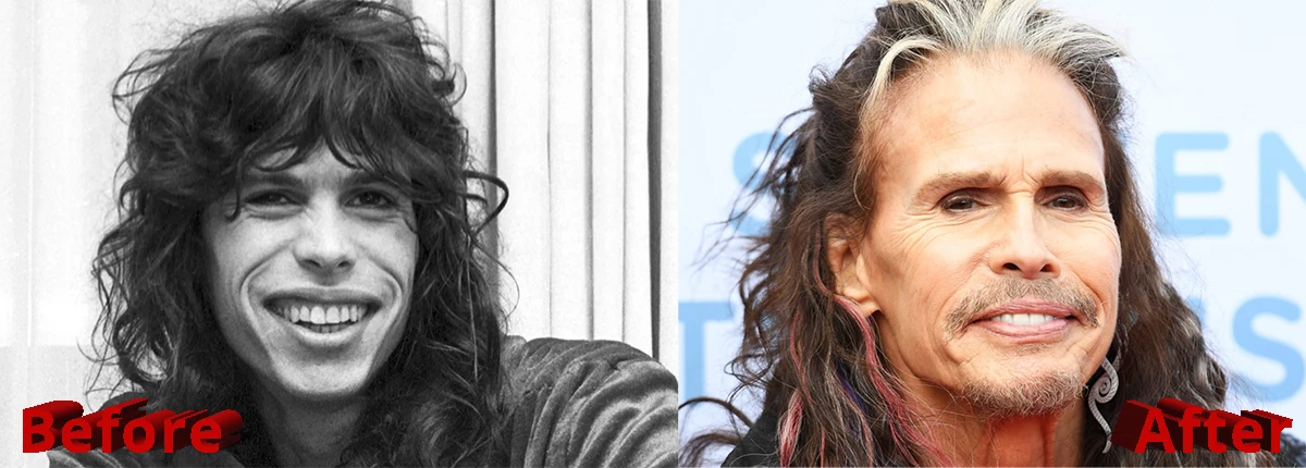 Steven Tyler Plastic Surgery Before and After
