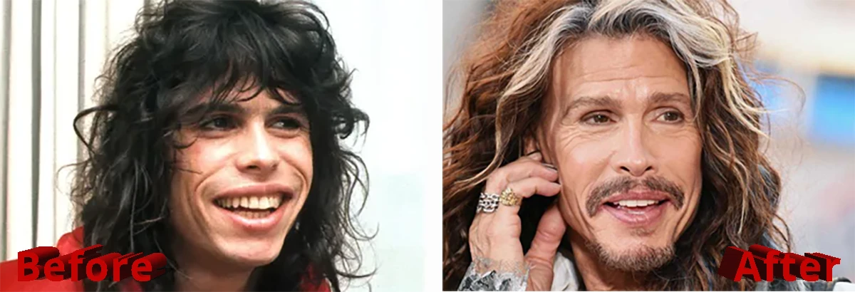 Steven Tyler Plastic Surgery