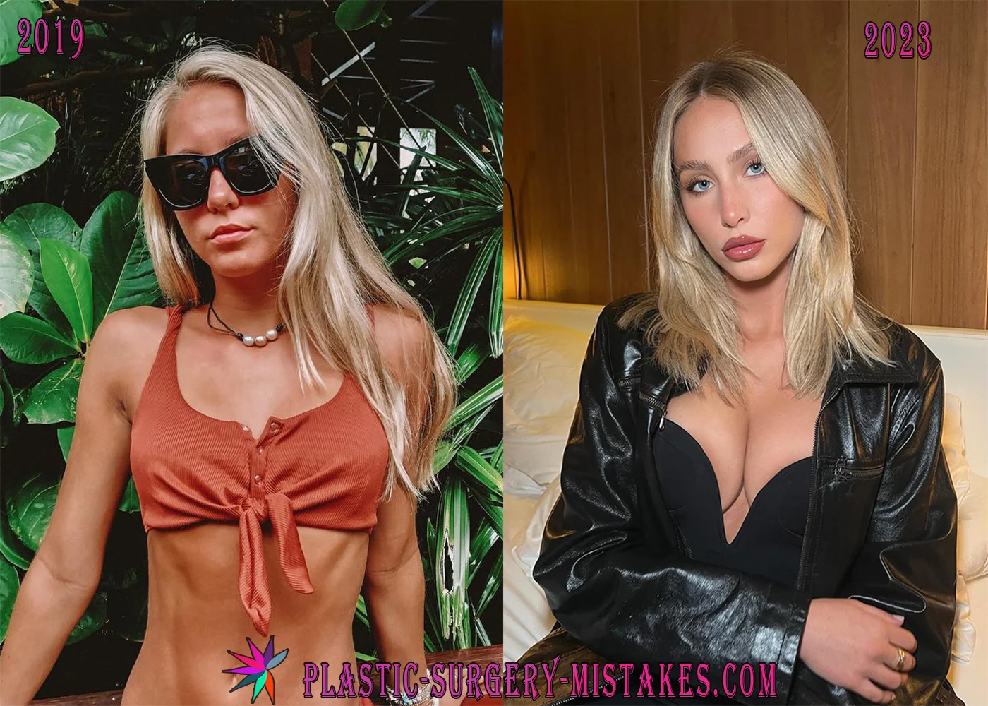 Alix Earle Before and After Boob Job Surgery Alix Earle Before And After Boob Job Surgery