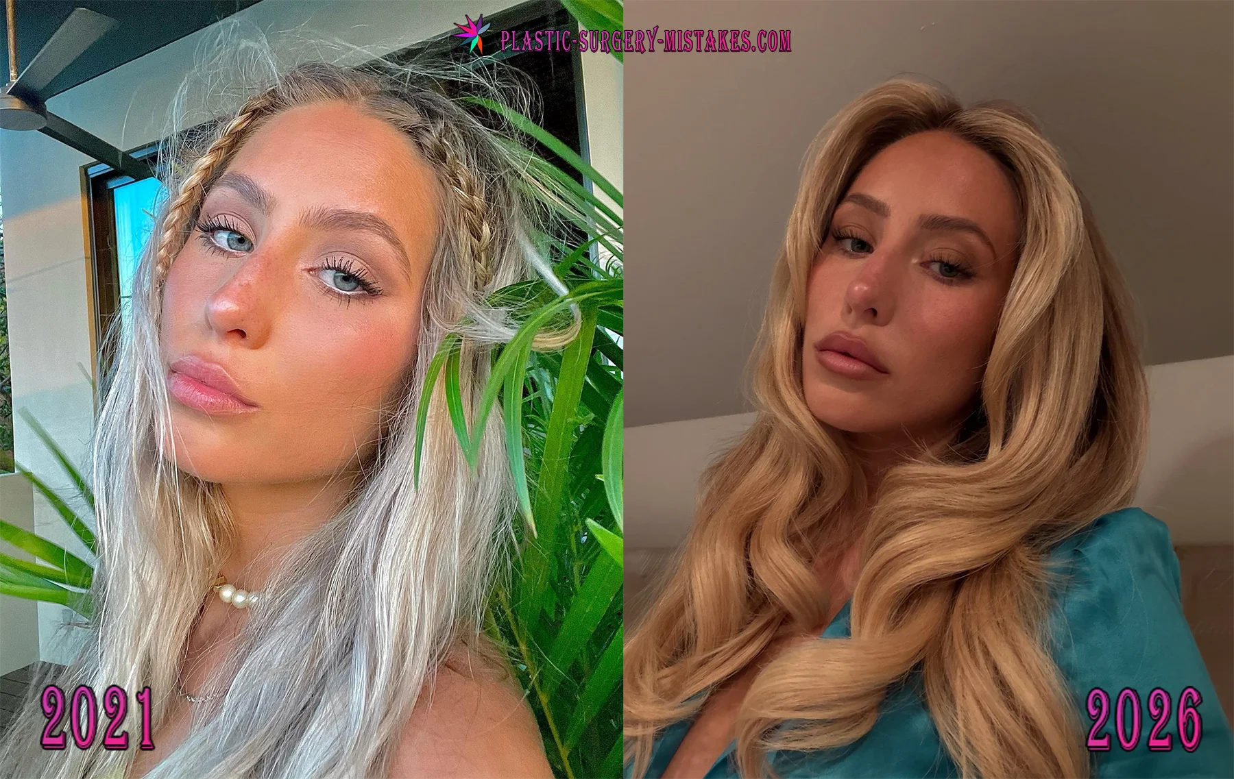 Alix Earle Before and After Nose Job Alix Earle Before And After Nose Job