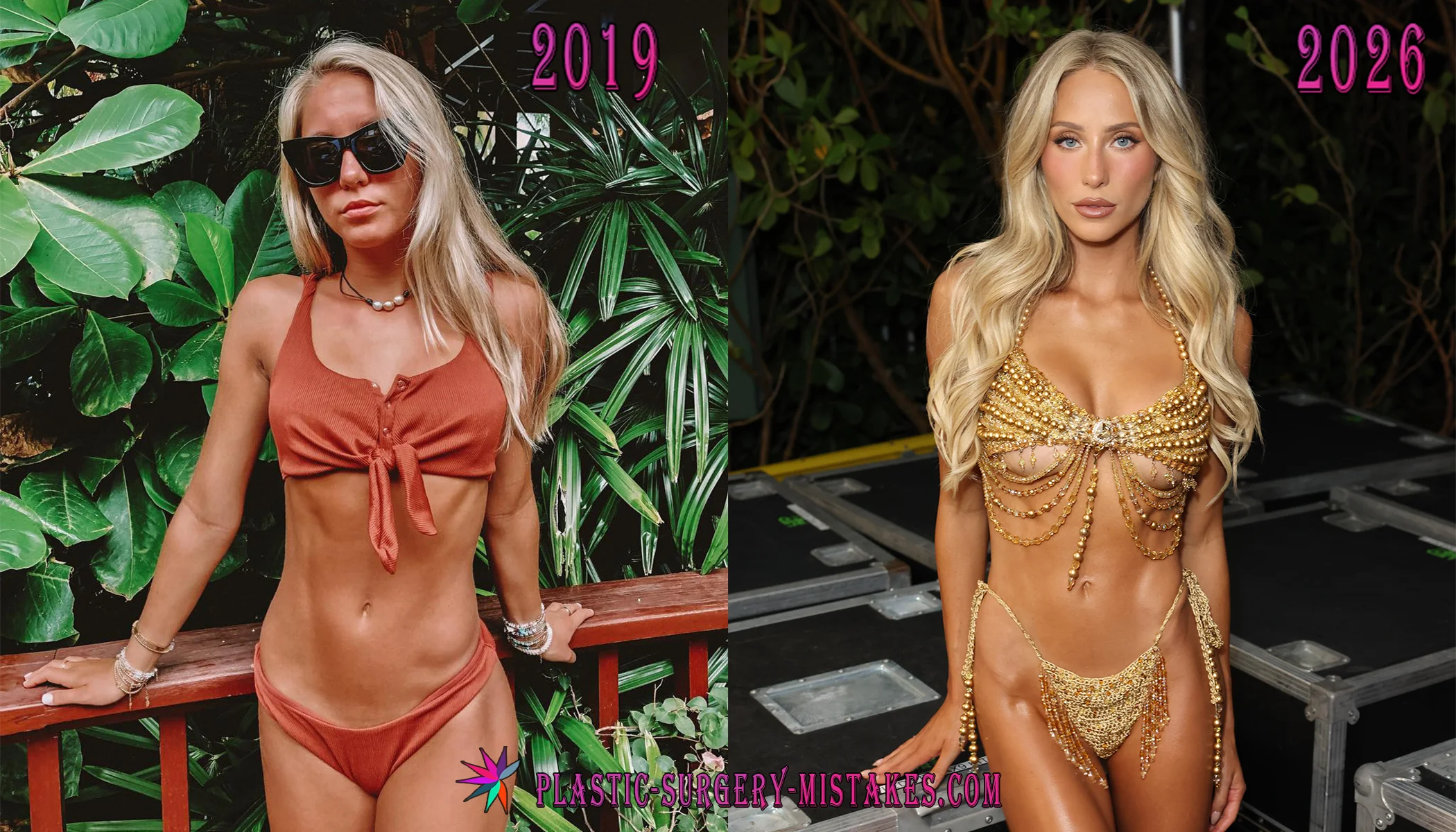 Alix Earle Before and After Plastic Surgery Alix Earle Before And After Plastic Surgery