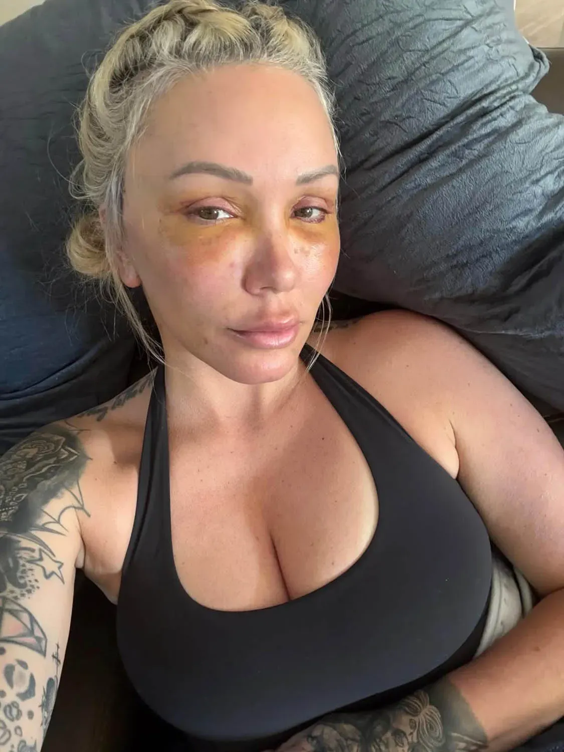 Bunnie XO After Facelift Plastic Surgery