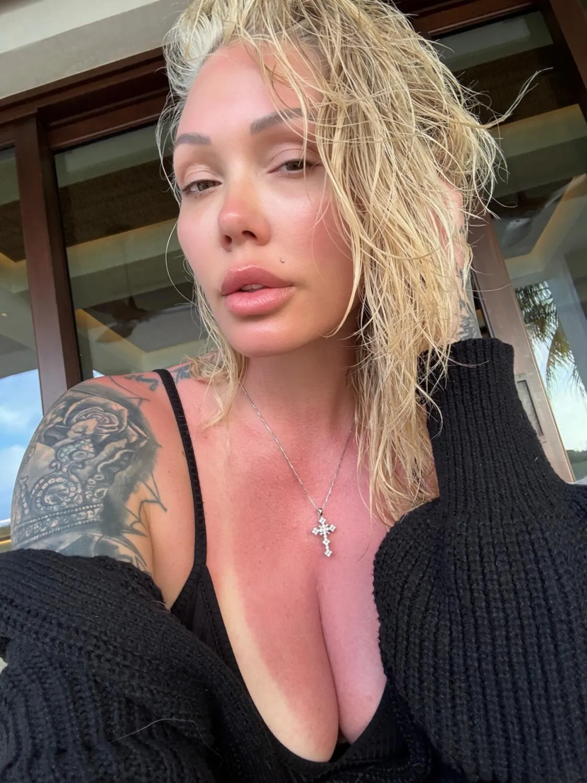 Bunnie XO with a significant sunburn