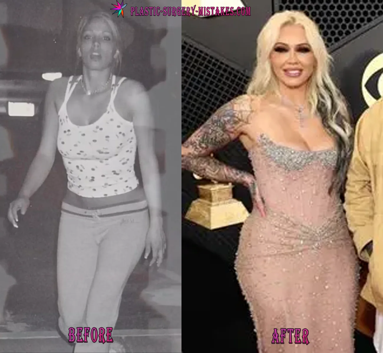Bunnie Xo Before and After Plastic Surgery