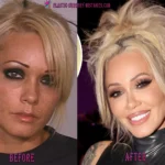 Bunnie Xo Plastic Surgery 150x150
