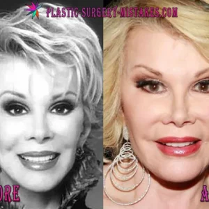 Joan Rivers Before And After Plastic Surgery