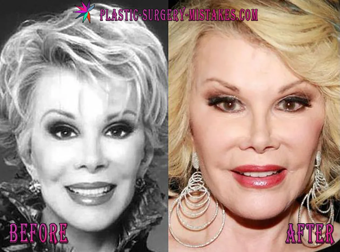 Joan Rivers Before And After Plastic Surgery