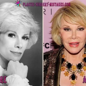 Joan Rivers Before And After Transformation