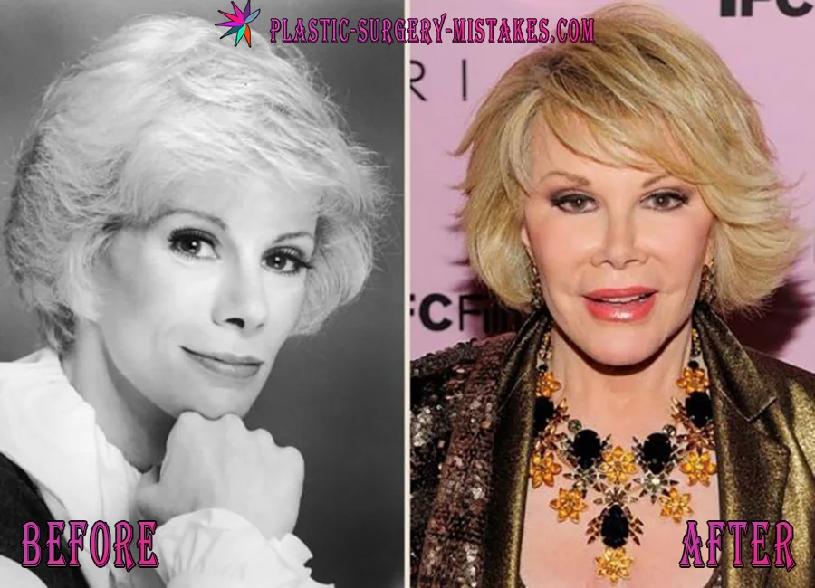 Joan Rivers Before And After Transformation