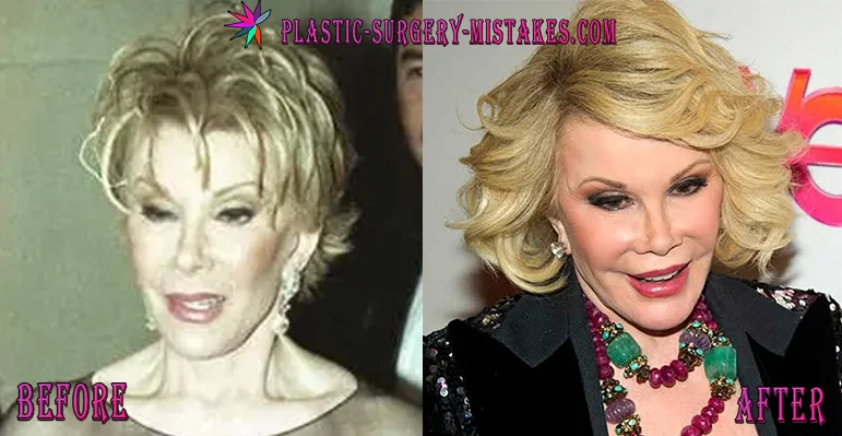 Joan Rivers Plastic Surgery Before And After