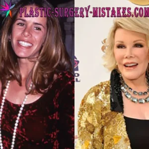 Joan Rivers and Melissa Rivers Plastic Surgery Before and After