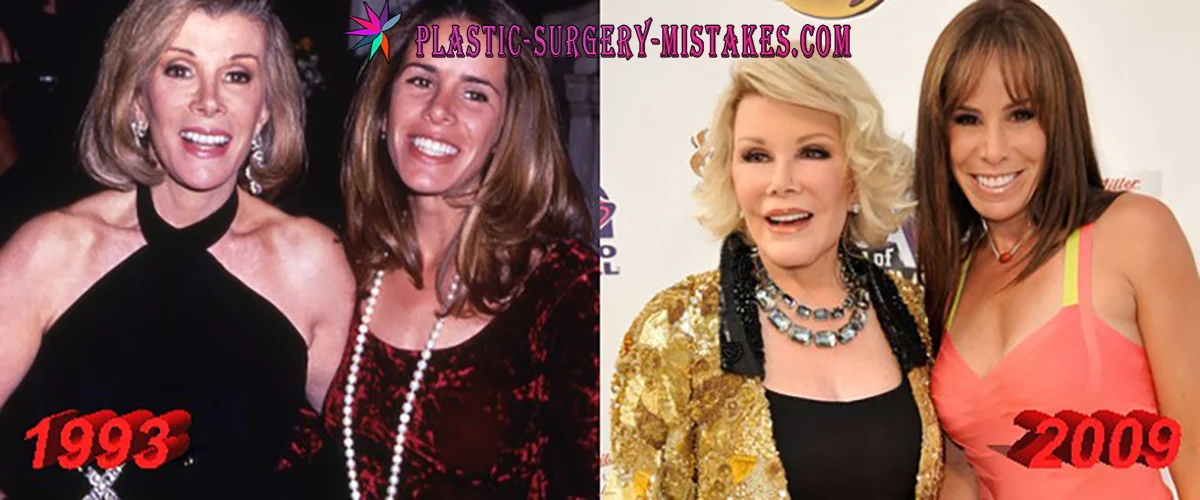 💉 Joan Rivers Plastic Surgery: The Wild Confessions, Iconic Procedures & Overdone Look Revealed 👑