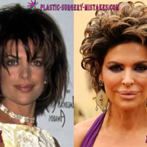 Lisa Rinna Before and After Plastic Surgery