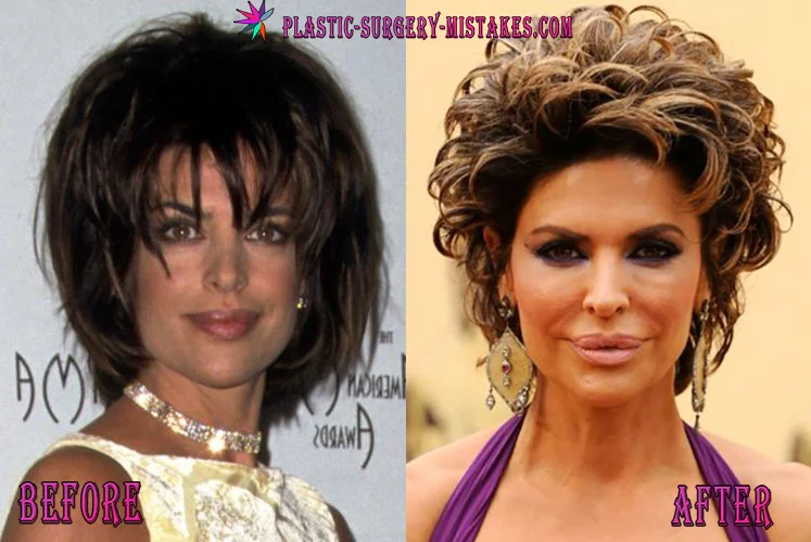 Lisa rinna After Lip Job Fail