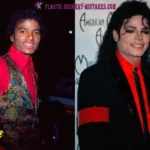 Michael Jackson Plastic Surgery Before and After