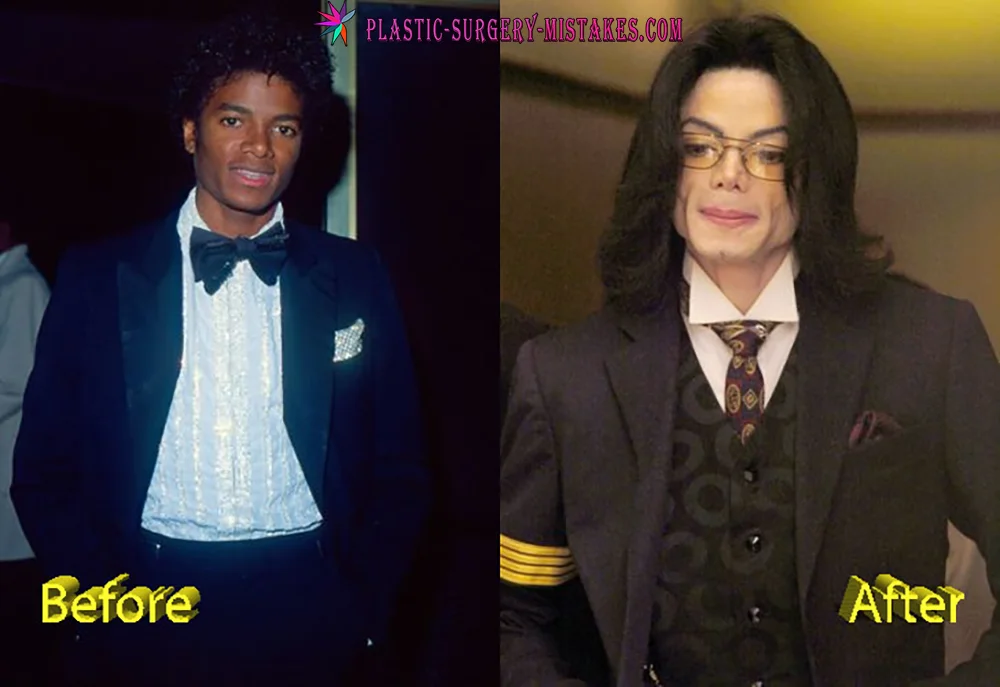 Michael Jackson Plastic Surgery Disaster Michael Jackson Plastic Surgery Disaster
