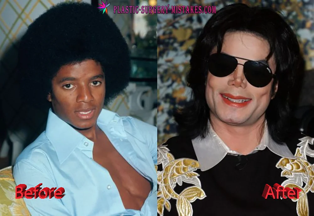 Michael Jackson Plastic Surgery Michael Jackson Plastic Surgery