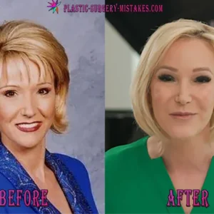 Paula White Before and After Botox Treatments