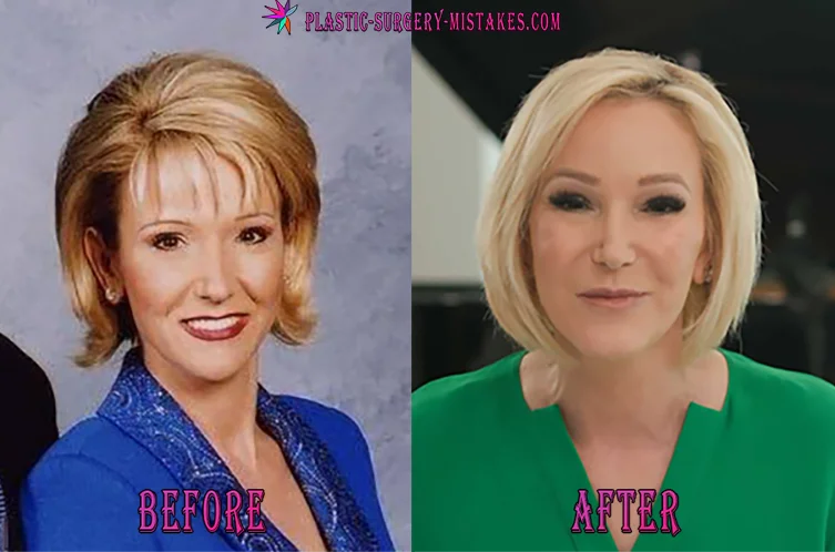 Paula White Before and After Botox Treatments Paula White Before And After Botox Treatments