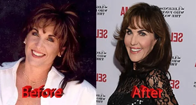 Robin McGraw Before and After Robin McGraw Before and After Plastic Surgery