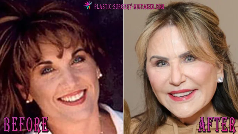 Robin McGraw Plastic Surgery Before and After Robin McGraw Before and After Plastic Surgery