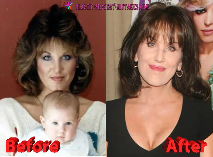 Robin McGraw Plastic Surgery Robin McGraw Before and After Plastic Surgery