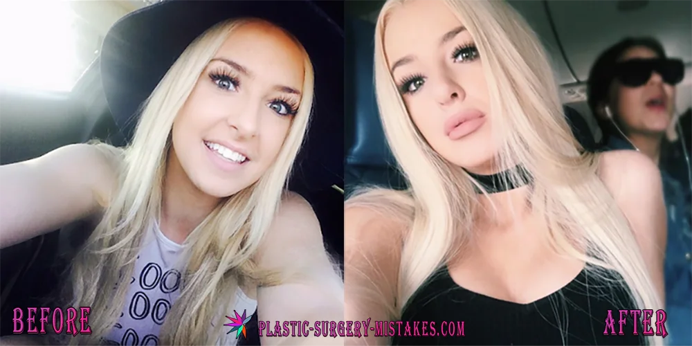 Tana Mongeau Before and After Plastic Surgery Tana Mongeau Before And After Plastic Surgery