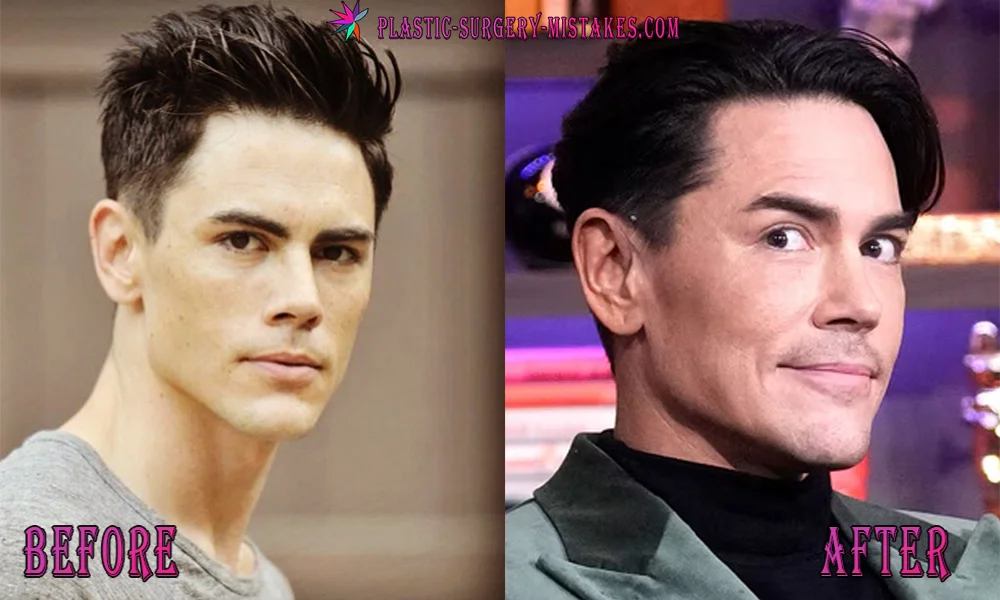 Tom Sandoval Plastic Surgery: The Shocking Truth! π